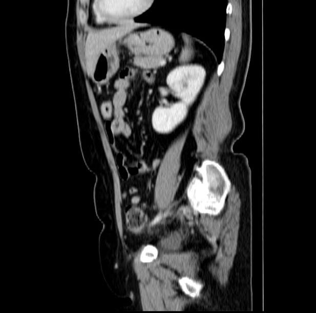 Colon carcinoma with hepatic metastases (Radiopaedia 29477-29961 C 38).jpg