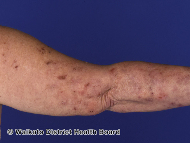 File:Dermatitis herpetiformis (DermNet NZ dermatitis-herpetiformis-elbow).jpg