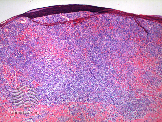 File:Figure 2 (DermNet NZ pathology-t-lypfigure2).jpg