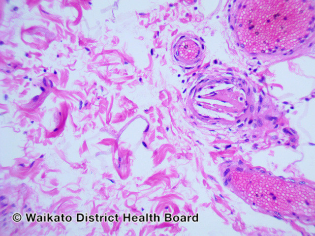 File:Figure 3 (DermNet NZ pathology-w-cholesterol-emboli-fig-3).jpg