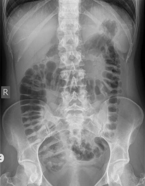 Figure 5.11 Normal Abdominal x-ray.jpg