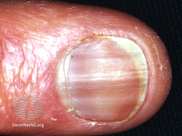 File:Nail pigmentation due to hydroxyurea (DermNet NZ brown-hyu).jpg