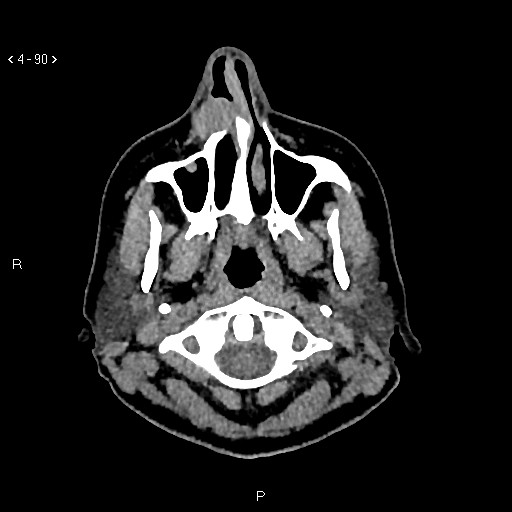Nasolabial cyst (Radiopaedia 75125-86194 Axial non-contrast 52).jpg