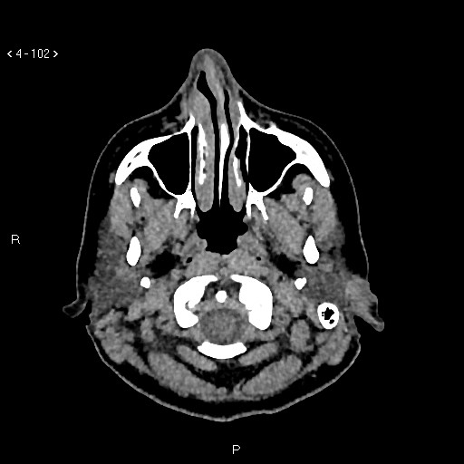 Nasolabial cyst (Radiopaedia 75125-86194 Axial non-contrast 64).jpg