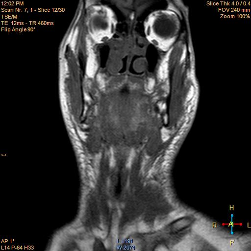 File:Nasopharyngeal carcinoma (Radiopaedia 22375-22403 Coronal T1 3).jpg