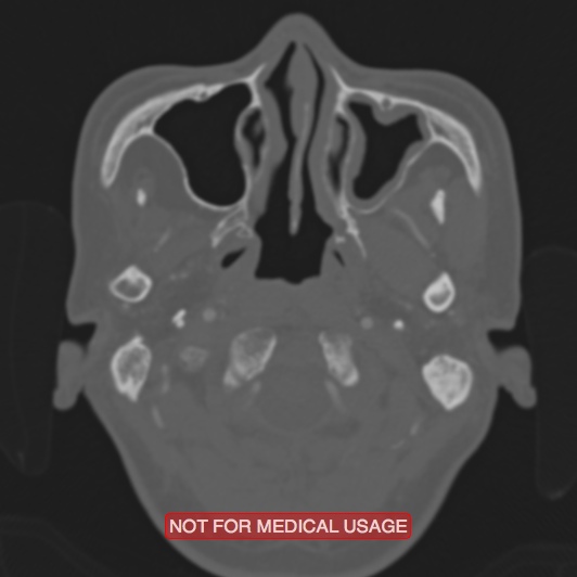 File:Nasopharyngeal carcinoma recurrence - skull base destruction (Radiopaedia 29107-29490 Axial bone window 97).jpg