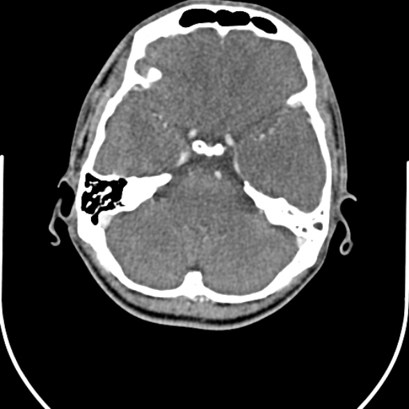 Nasopharyngeal carcinoma with skull base invasion (Radiopaedia 53415-59705 A 1).jpg