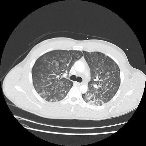 Near-drowning pulmonary edema (Radiopaedia 59457-66814 Axial lung window 21).jpg