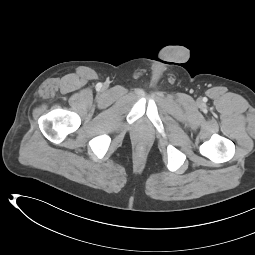File:Necrotizing pancreatitis with acute necrotic collections (Radiopaedia 38829-41012 B 90).png