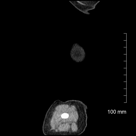 File:Neonatal neuroblastoma (Radiopaedia 56651-63438 C 9).jpg
