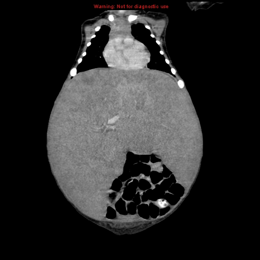 File:Neonatal neuroblastoma (Radiopaedia 9564-10223 B 49).jpg
