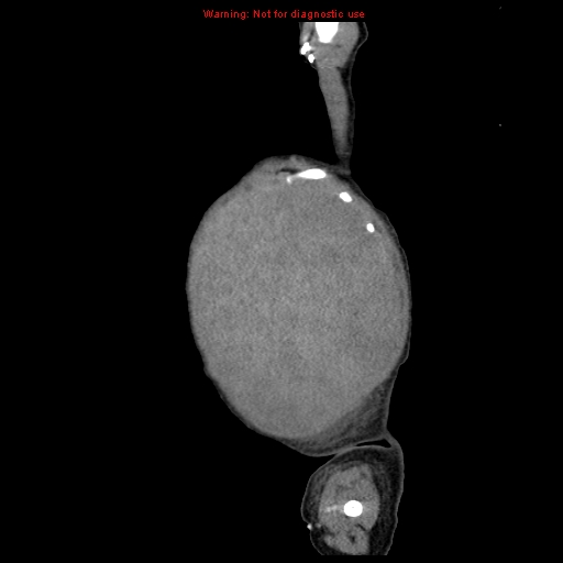 File:Neonatal neuroblastoma (Radiopaedia 9564-10223 C 18).jpg