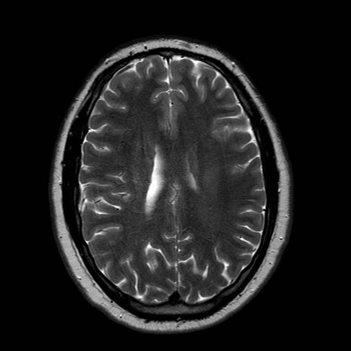 File:Neuro-Behcet's disease (Radiopaedia 21557-21506 Axial T2 18).jpg