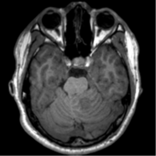 File:Neurofibromatosis type 2 (Radiopaedia 44936-48838 Axial T1 40).png