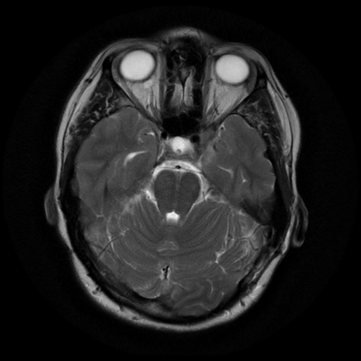File:Neurofibromatosis type 2 (Radiopaedia 45229-49247 Axial T2 8).png