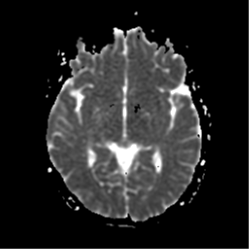 File:Neurofibromatosis type 2 - bilateral acoustic neuromata (Radiopaedia 40060-42566 Axial ADC 10).png