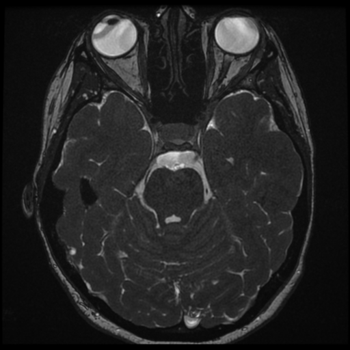 File:Neurofibromatosis type 2 - bilateral acoustic neuromata (Radiopaedia 40060-42566 Axial FIESTA 66).png