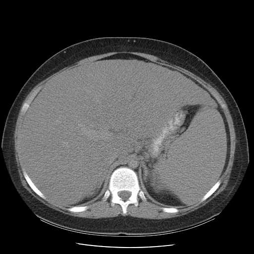 File:Non-Hodgkin lymphoma involving pelvis (Radiopaedia 21281-21197 B 20).jpg