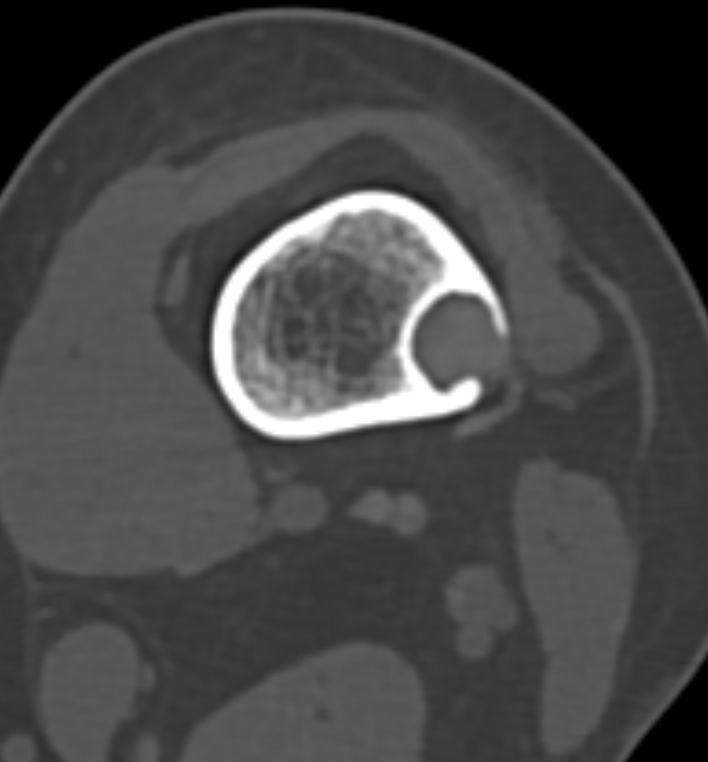 Non-ossifying fibroma - femur (Radiopaedia 82786-97042 Axial bone window 41).jpg
