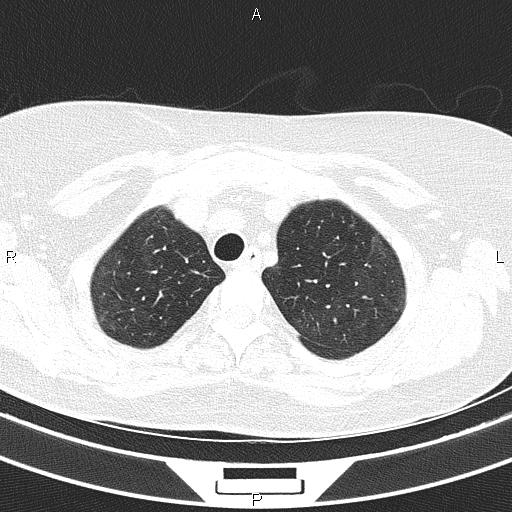 Non-specific interstitial pneumonia (Radiopaedia 83185-97567 Axial lung window 16).jpg
