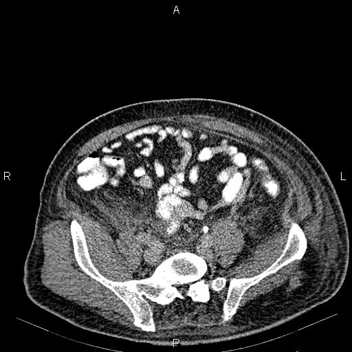 Non Hodgkin lymphoma in a patient with ankylosing spondylitis (Radiopaedia 84323-99621 Axial C+ delayed 56).jpg