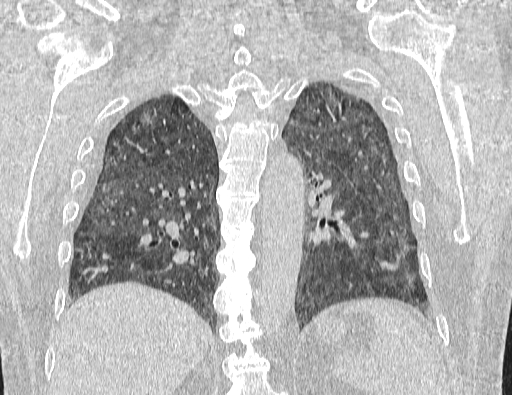 Non specific interstitial pneumonia (NSIP) (Radiopaedia 89725-106798 Coronal lung window 53).jpg