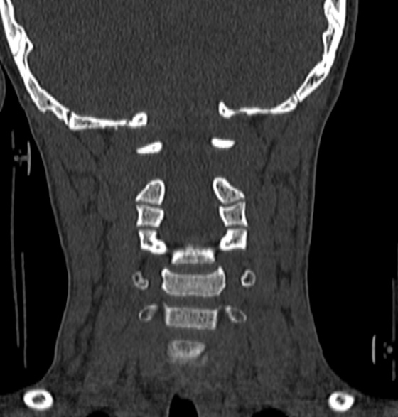 File:Normal CT cervical spine - 12-year-old (Radiopaedia 55352-61775 Coronal bone window 111).jpg