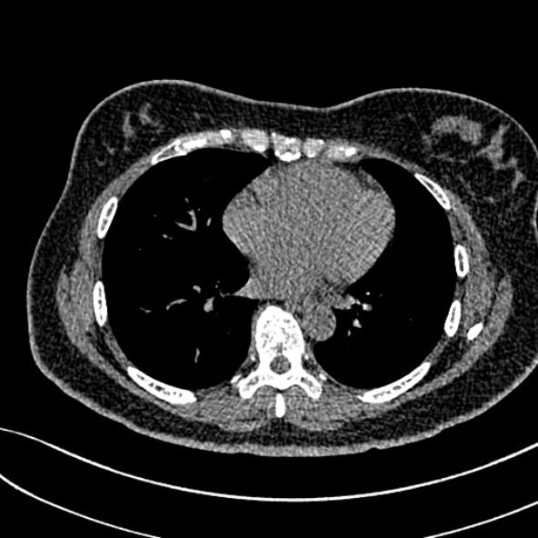 Normal CT chest- adult female (Radiopaedia 52522-58428 Axial non-contrast 78).jpg