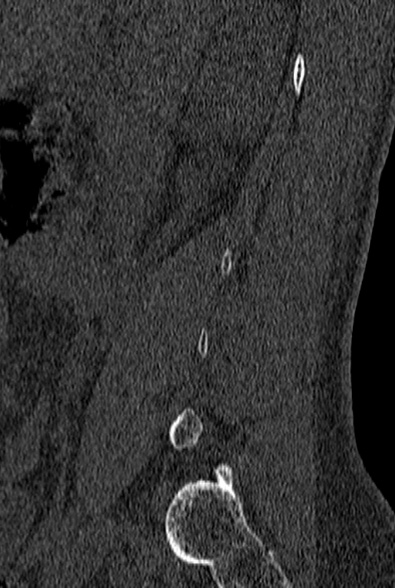 File:Normal CT lumbar spine (Radiopaedia 53981-60118 Sagittal bone window 10).jpg