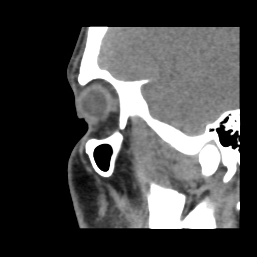 Normal CT paranasal sinuses (Radiopaedia 42286-45390 F 37).jpg