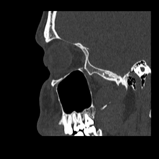 Normal CT paranasal sinuses (Radiopaedia 42286-45390 Sagittal bone window 80).jpg