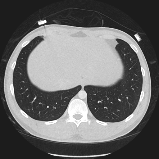 Normal CT pulmonary veins (pre RF ablation) (Radiopaedia 41748-44702 Axial lung window 57).png