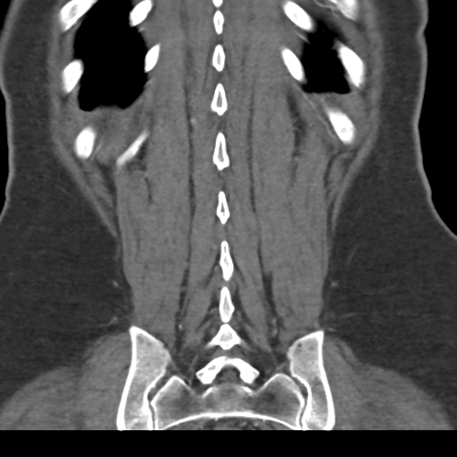 File:Normal CT renal artery angiogram (Radiopaedia 38727-40889 B 65).png