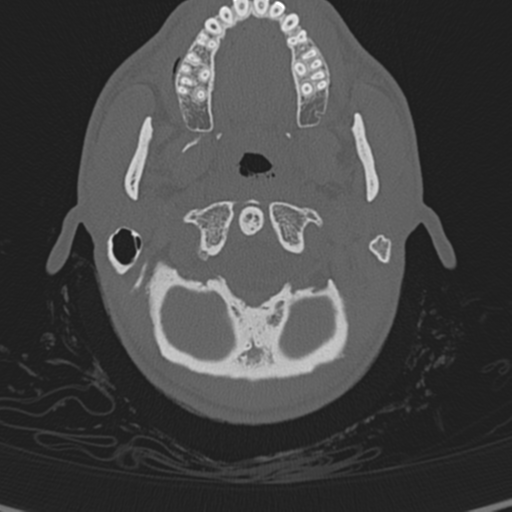 Normal CT skull (Radiopaedia 40798-43459 A 9).png