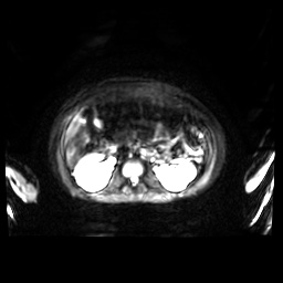 Normal MRI abdomen in pregnancy (Radiopaedia 88001-104541 Axial DWI 31).jpg
