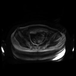 Normal MRI abdomen in pregnancy (Radiopaedia 88001-104541 Axial DWI 92).jpg