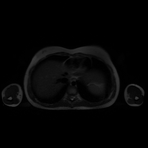 File:Normal MRI abdomen in pregnancy (Radiopaedia 88001-104541 Axial T2 4).jpg