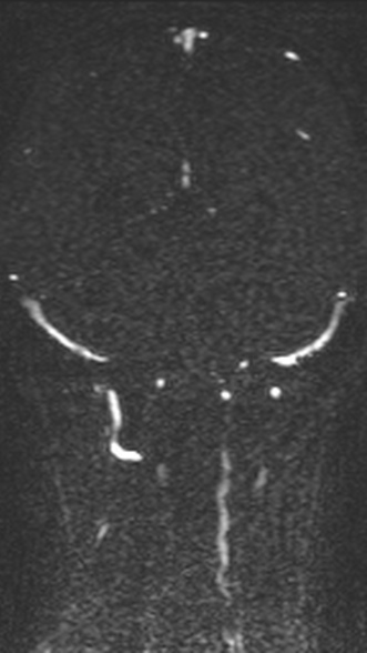 Normal MRI brain with MRV- teenager (Radiopaedia 49425-54553 Coronal MRV 165).jpg