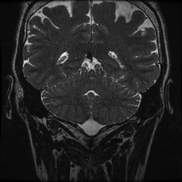 Normal MRI petrous (Radiopaedia 91317-108949 Coronal T2 96).jpg