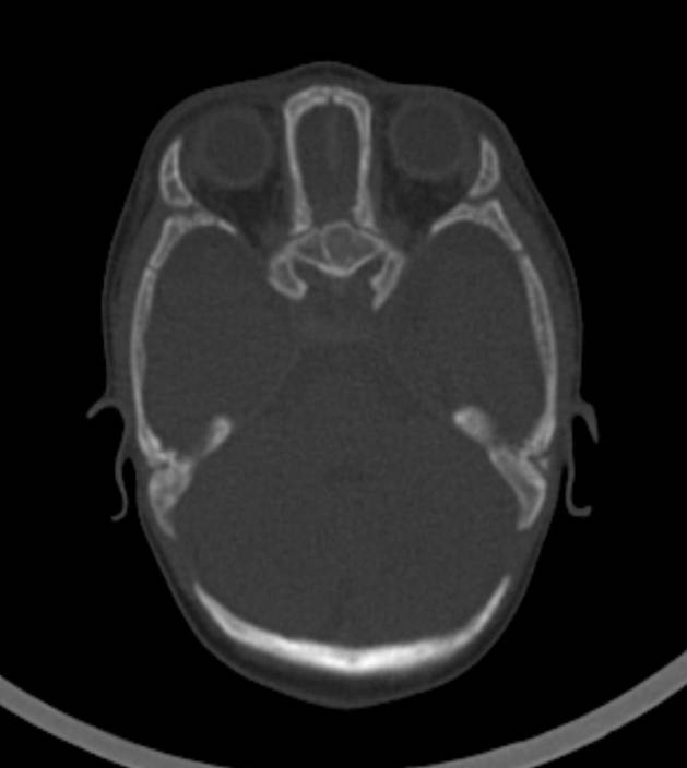 Normal brain CT - 2-month-old (Radiopaedia 53369-59350 Axial bone window 44).jpg
