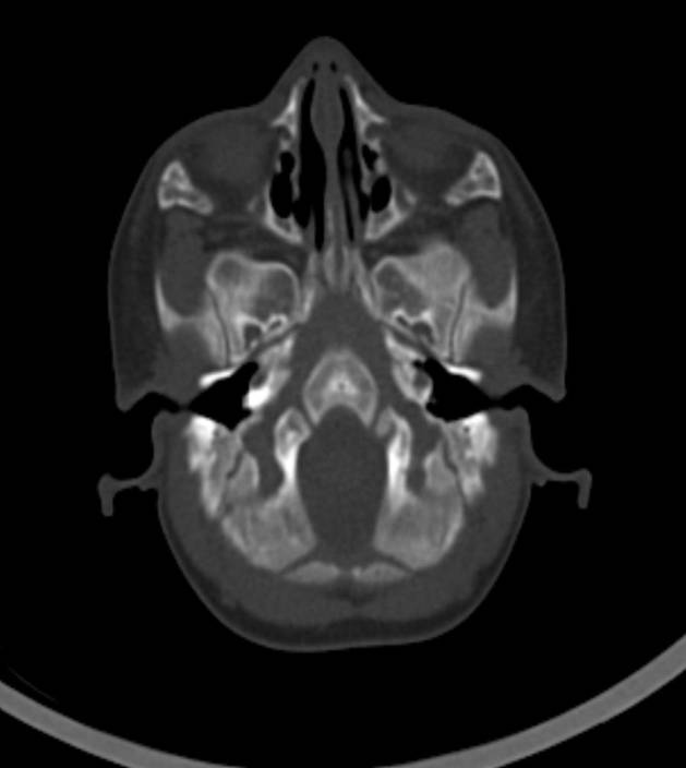 Normal brain CT - 2-month-old (Radiopaedia 53369-59350 Axial bone window 52).jpg