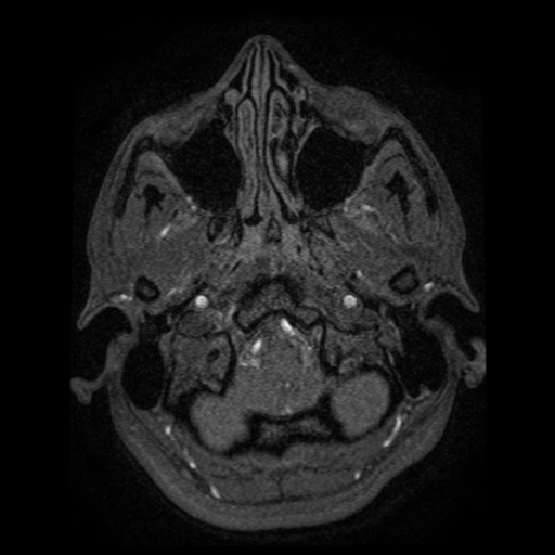 Normal brain MRA (Radiopaedia 41046-43793 Axial MRA 116).png