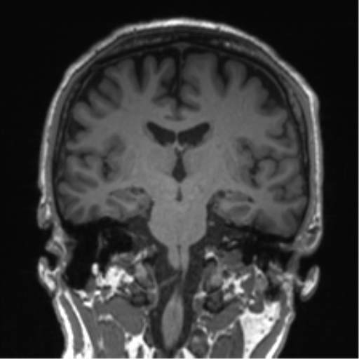 Normal brain MRI (non-focal epilepsy protocol) (Radiopaedia 53917-60040 Coronal T1 34).png