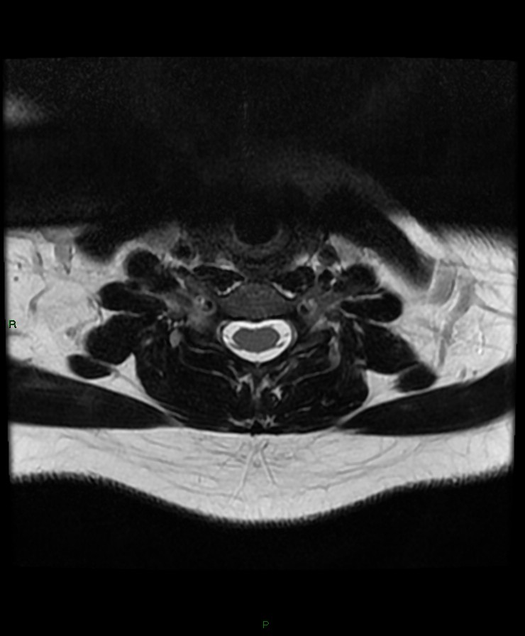 Normal cervical spine MRI (Radiopaedia 80146-93454 Axial T2 66).jpg