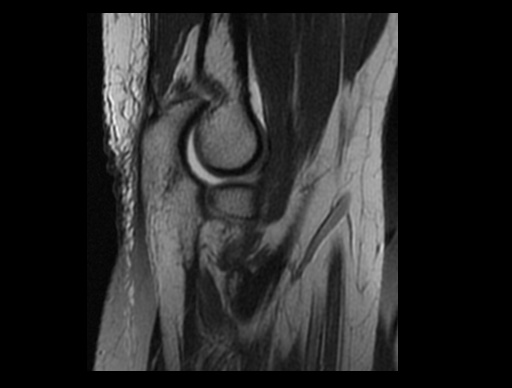 File:Normal elbow arthrograms (Radiopaedia 75550-86805 Sagittal PD 19).jpg