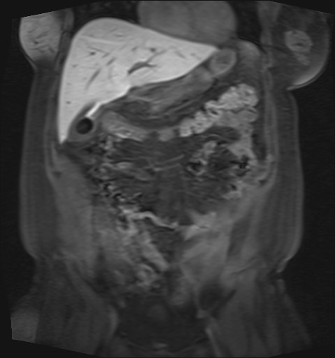 File:Normal hepatobiliary phase liver MRI (Radiopaedia 58968-66230 B 36).jpg