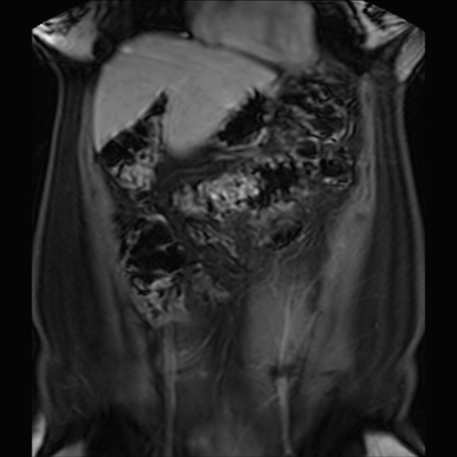Normal liver MRI with Gadolinium (Radiopaedia 58913-66163 P 24).jpg
