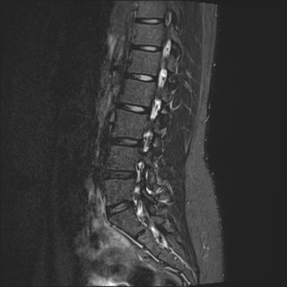 File:Normal lumbar spine MRI- 3 T (Radiopaedia 53280-59250 Sagittal STIR 10).jpg