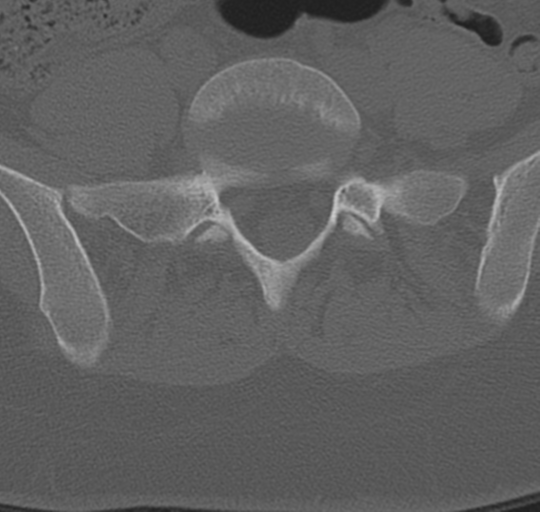 File:Normal lumbosacral CT (Radiopaedia 37923-39867 Axial bone window 79).png