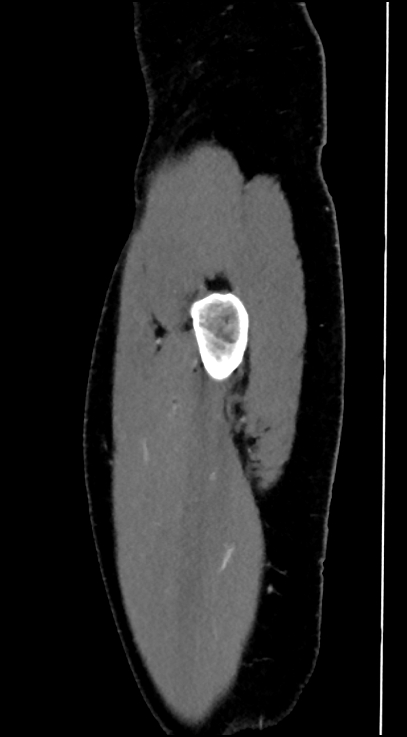 Normal pelvis CT angiogram (Radiopaedia 84966-100481 C 6).jpg